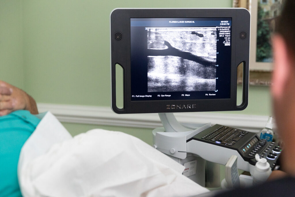 A vein specialist at Florida Lakes Vein Center uses ultrasound technology to determine if a vein needs sclerotherapy near Sarasota. The vein specialist looks at the monitor screen which shows the vein ultrasound.