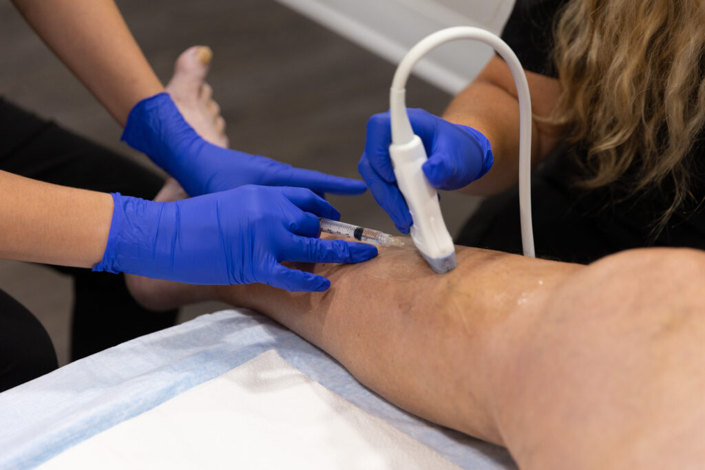 We see 2 sets of provider hands delivering Varithena near Bradenton. One set guides using an ultra sound device while the other uses a hypodermic to inject Verithena into the varicose vein.