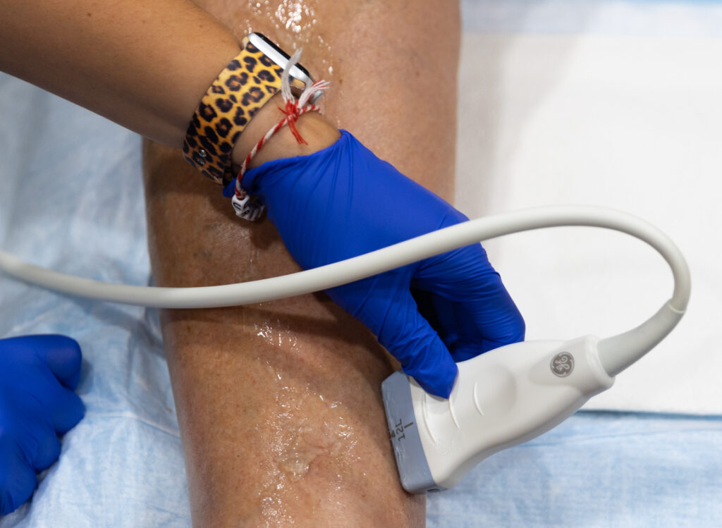 A hand wearing surgical gloves holds a VenaSeal applicator, performing a venous ulcer treatment near Sarasota.