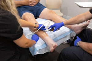 A wide shot of a patients legs while two providers perform a varicose vein treatment near Longboat Key.