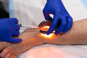 Two hands in medical gloves performing sclerotherapy for spider vein treatment near Longboat Key.