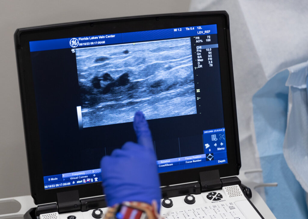 The gloved hand of a provider points to an issue showing on an ultrasound screen. Using this information, the provider can help identify is VenaSeal in Brandenton, FL, is the correct treatment.