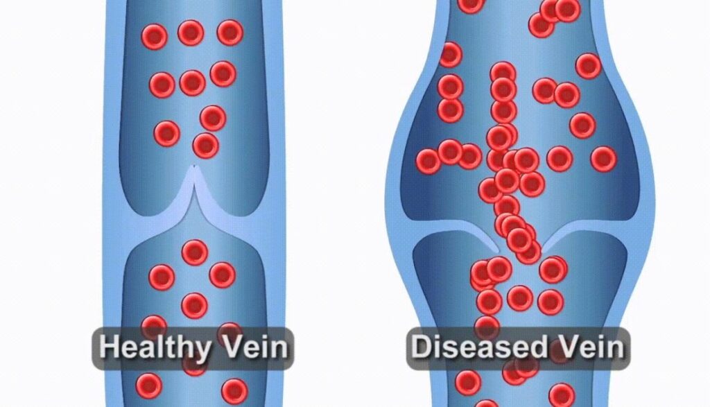 A side-by-side graphic shows the difference between a healthy vein and a diseased vein. The diseased vein is larger and has malfunctioning valves compared to the healthy vein, meaning a patient should seek varicose vein treatment near Myakka City.